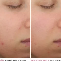 It CosmeticsBye Bye Breakout Sérum anti-acné à l'acide salicylique