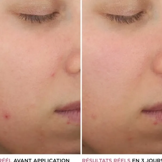 It CosmeticsBye Bye Breakout Sérum anti-acné à l'acide salicylique